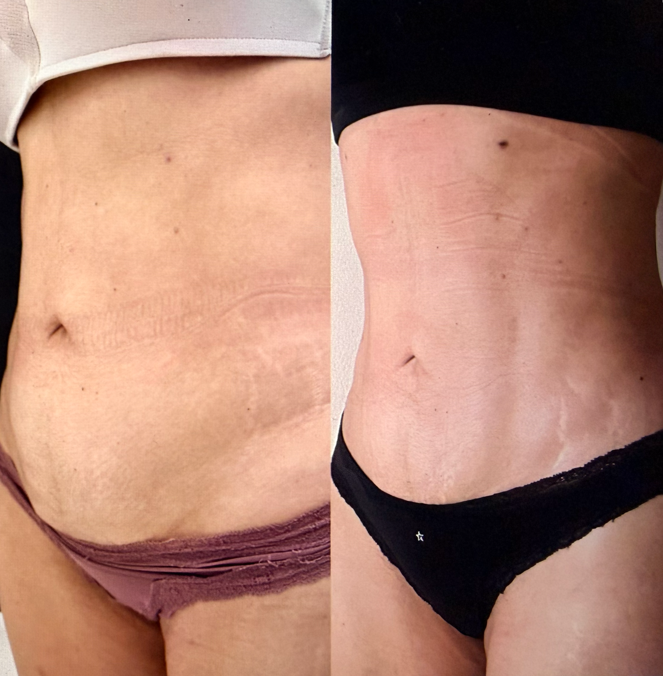 Abdominal before and after comparison showing body contour refinement